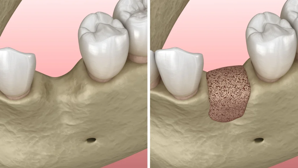 Greffe osseuse dentaire avant la pose d'un implant dentaire