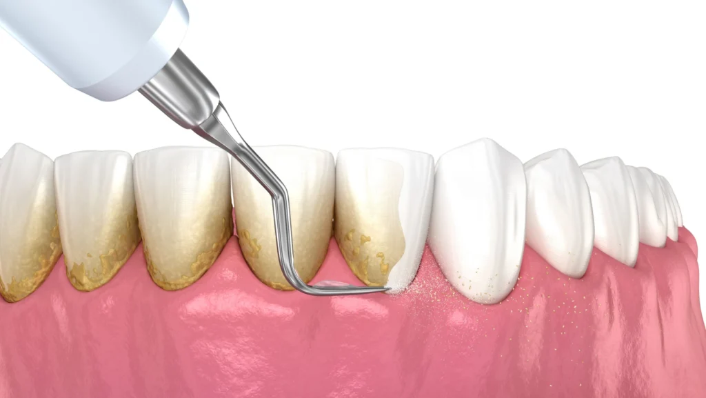 Le détartrage : un soin essentiel pour vos dents