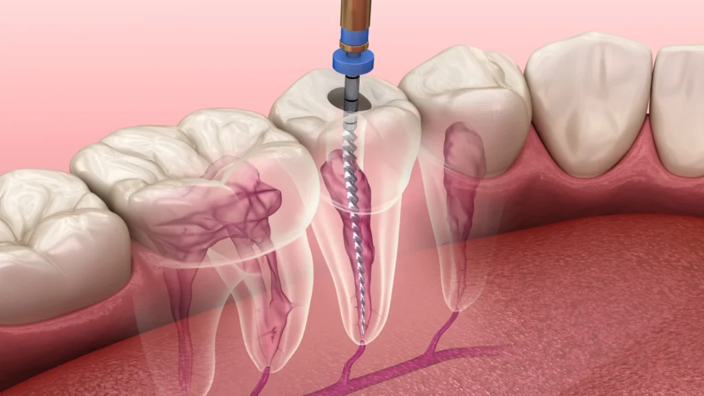 Tout savoir sur la dévitalisation d’une dent 
