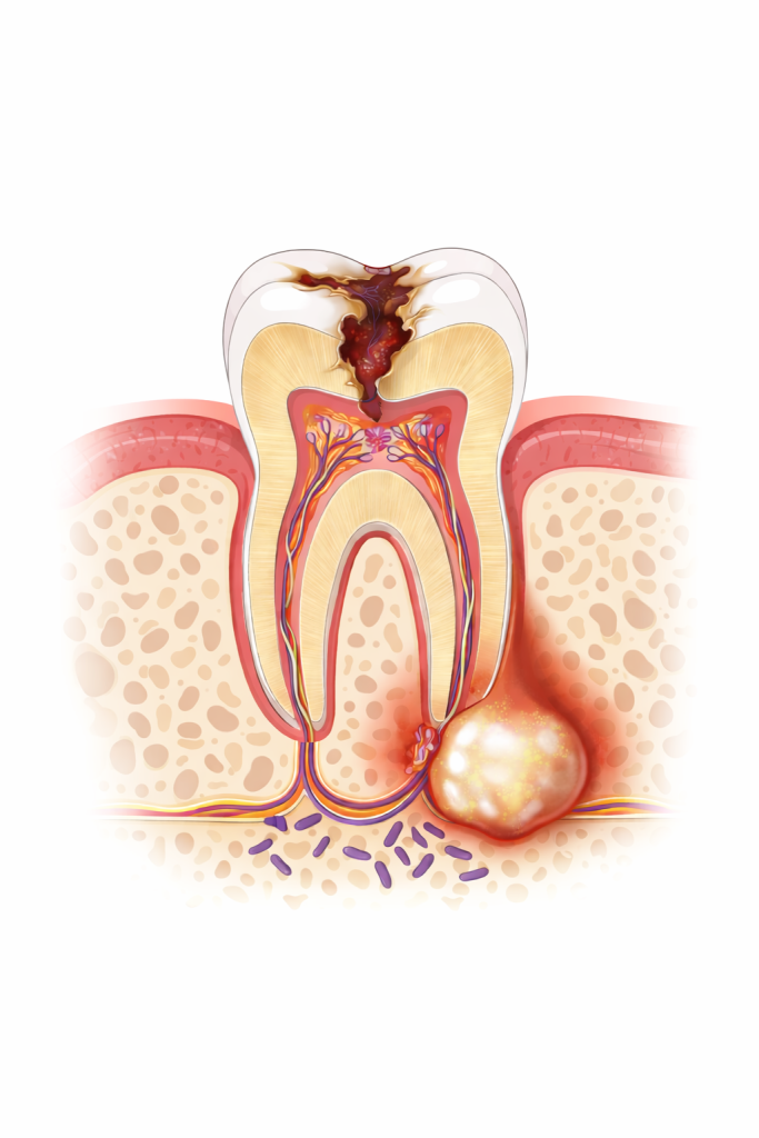 Abcès dentaire : que faire en cas de douleur ou de gonflement ?